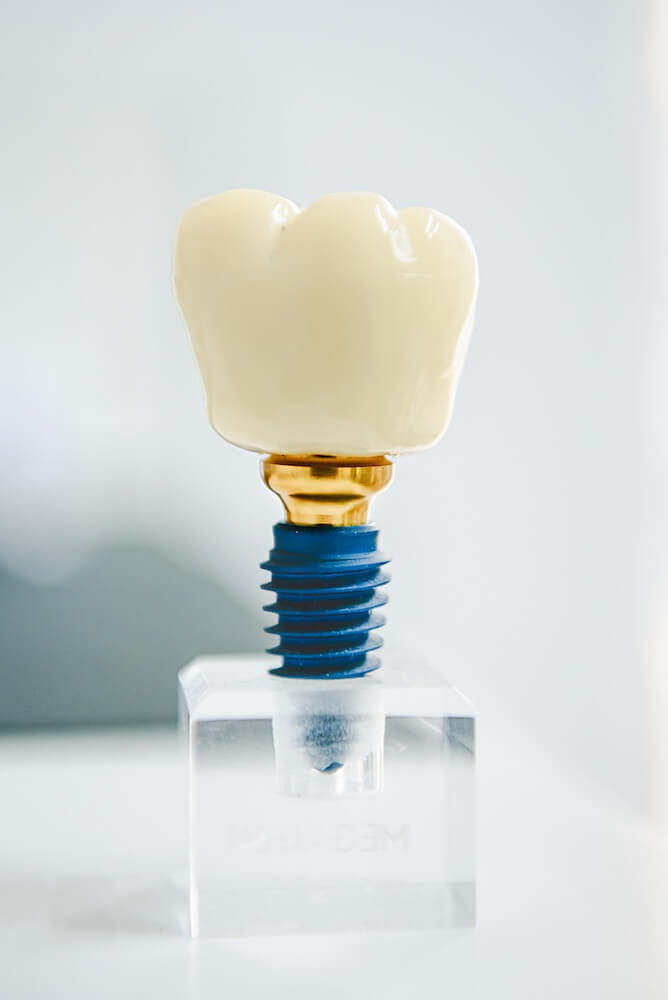 Εμφυτεύματα Δοντιών