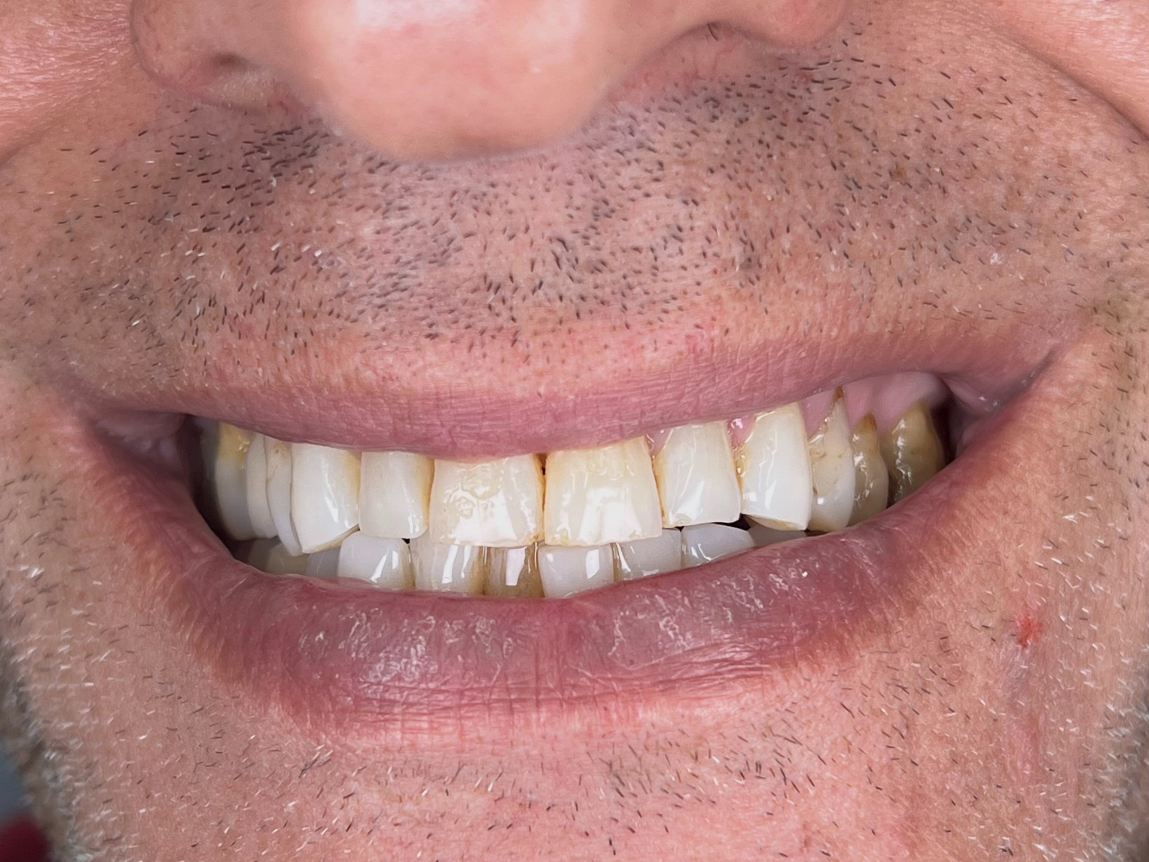 θήκες ζιρκονίας before