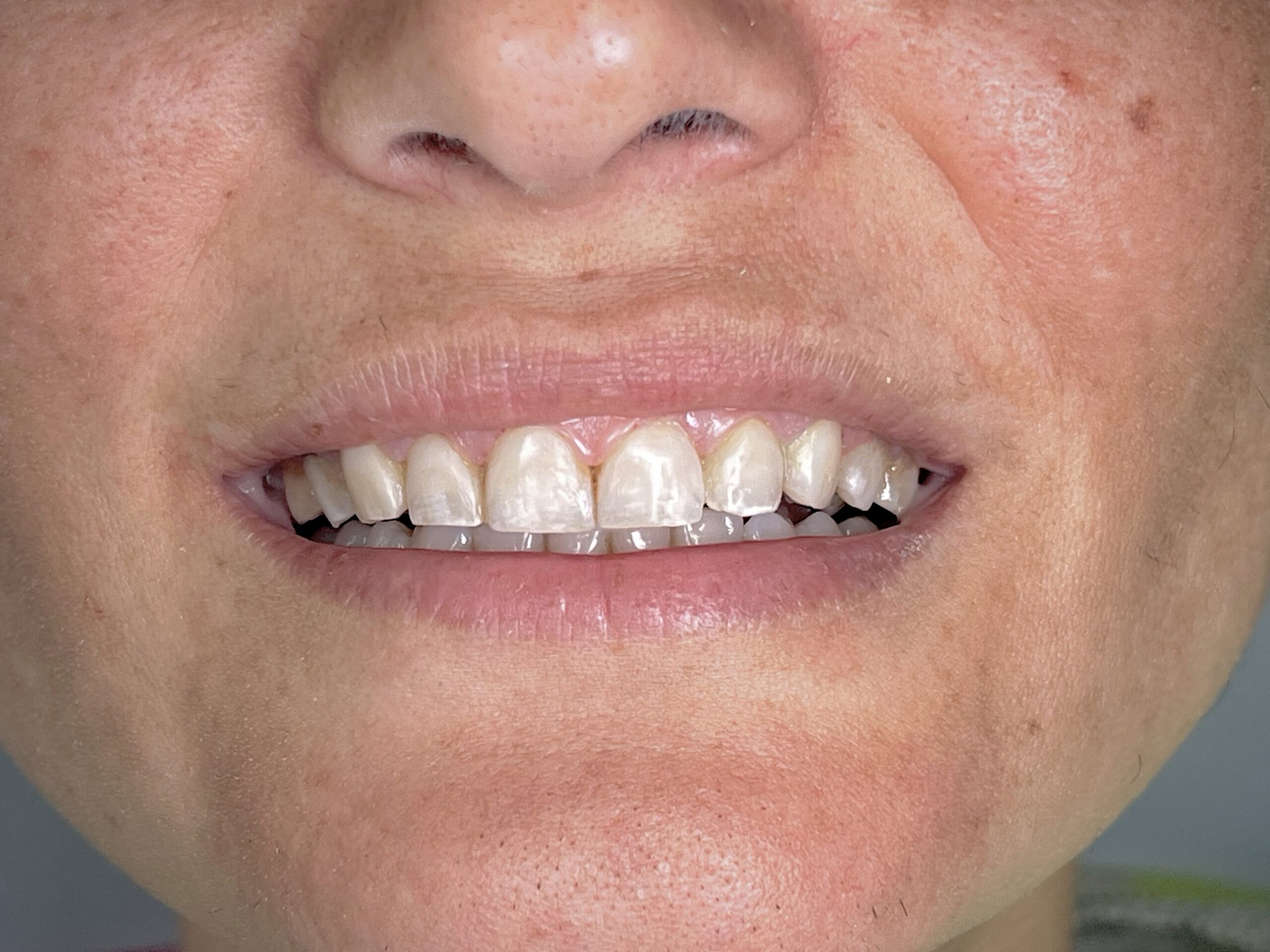 Όψεις ρητίνης After