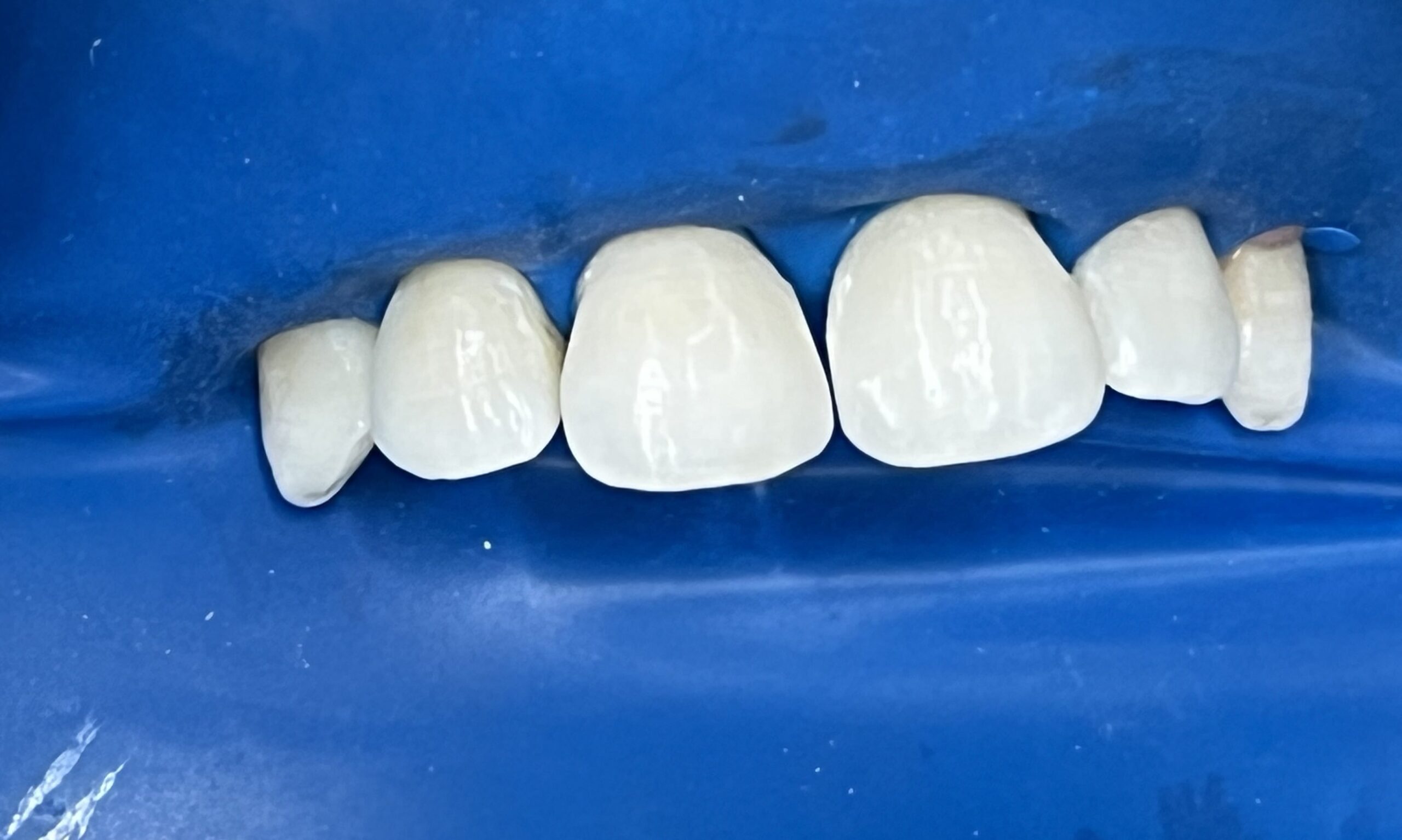 Όψεις ρητίνης After