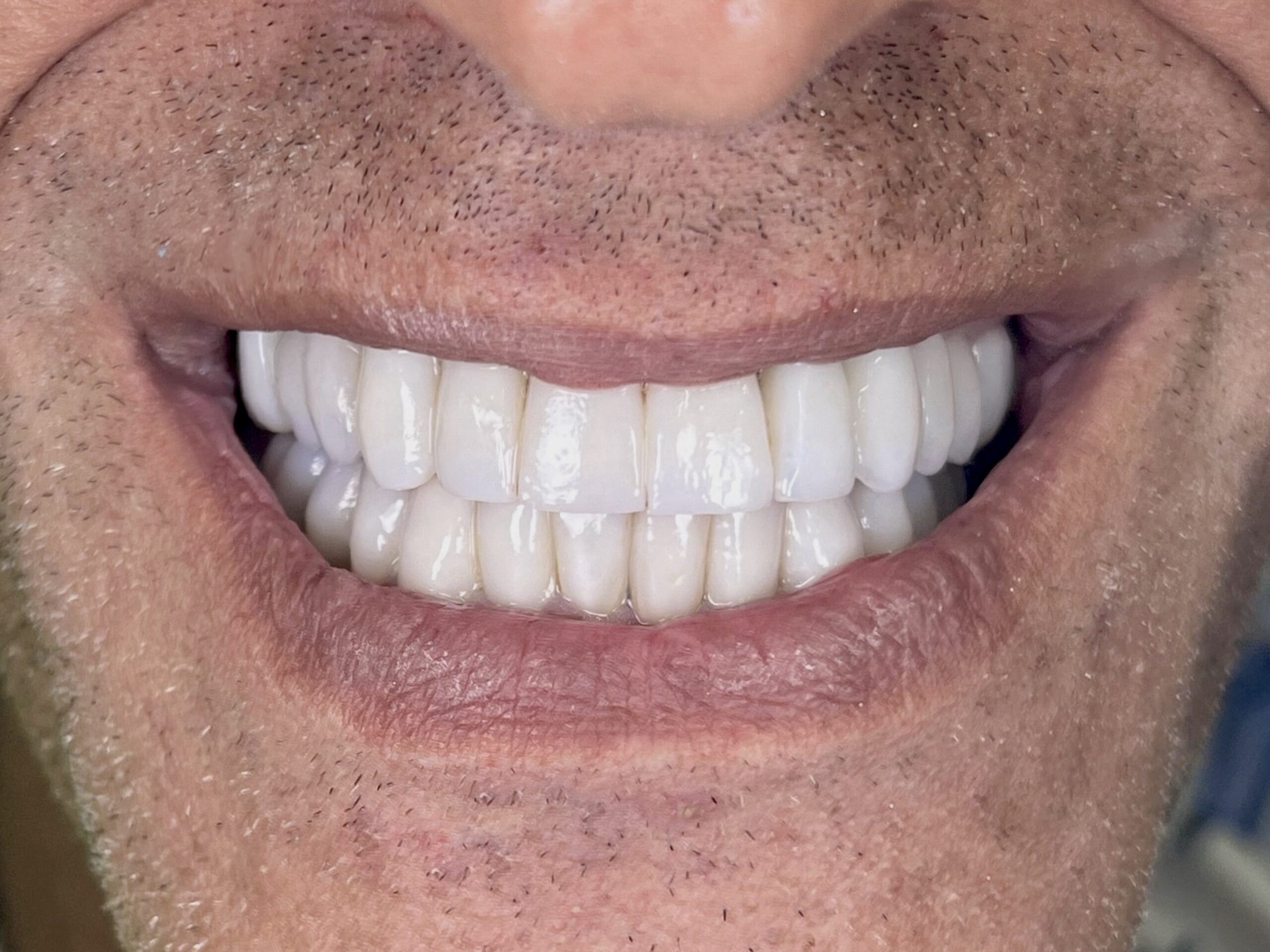 Θήκες ζιρκονίας After