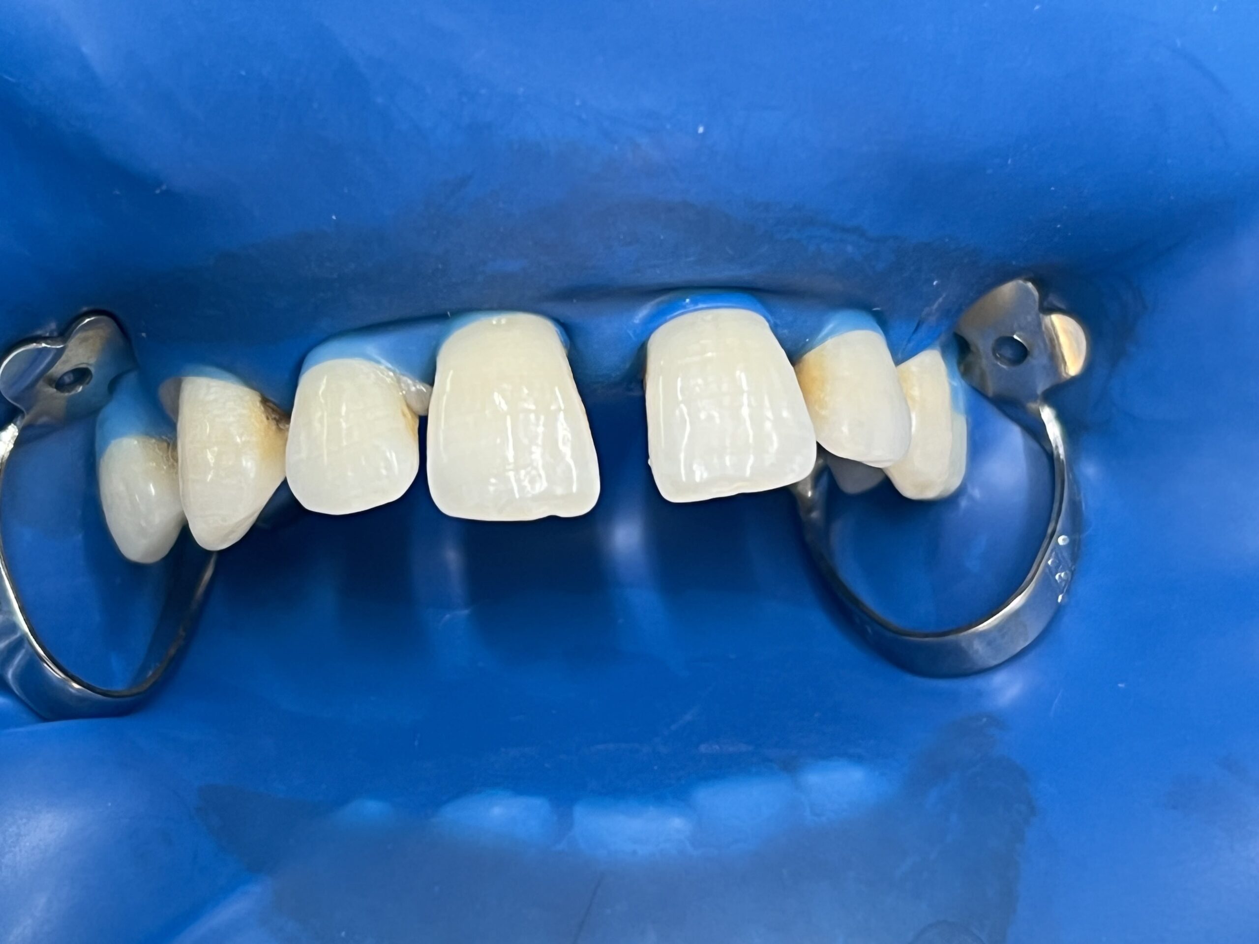 Όψεις ρητίνης Before