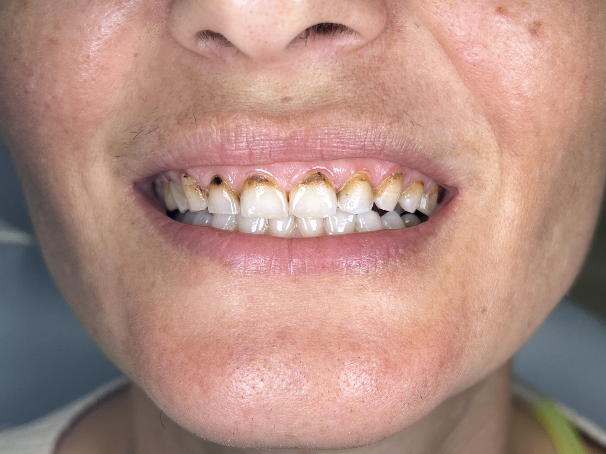 Όψεις ρητίνης Βefore