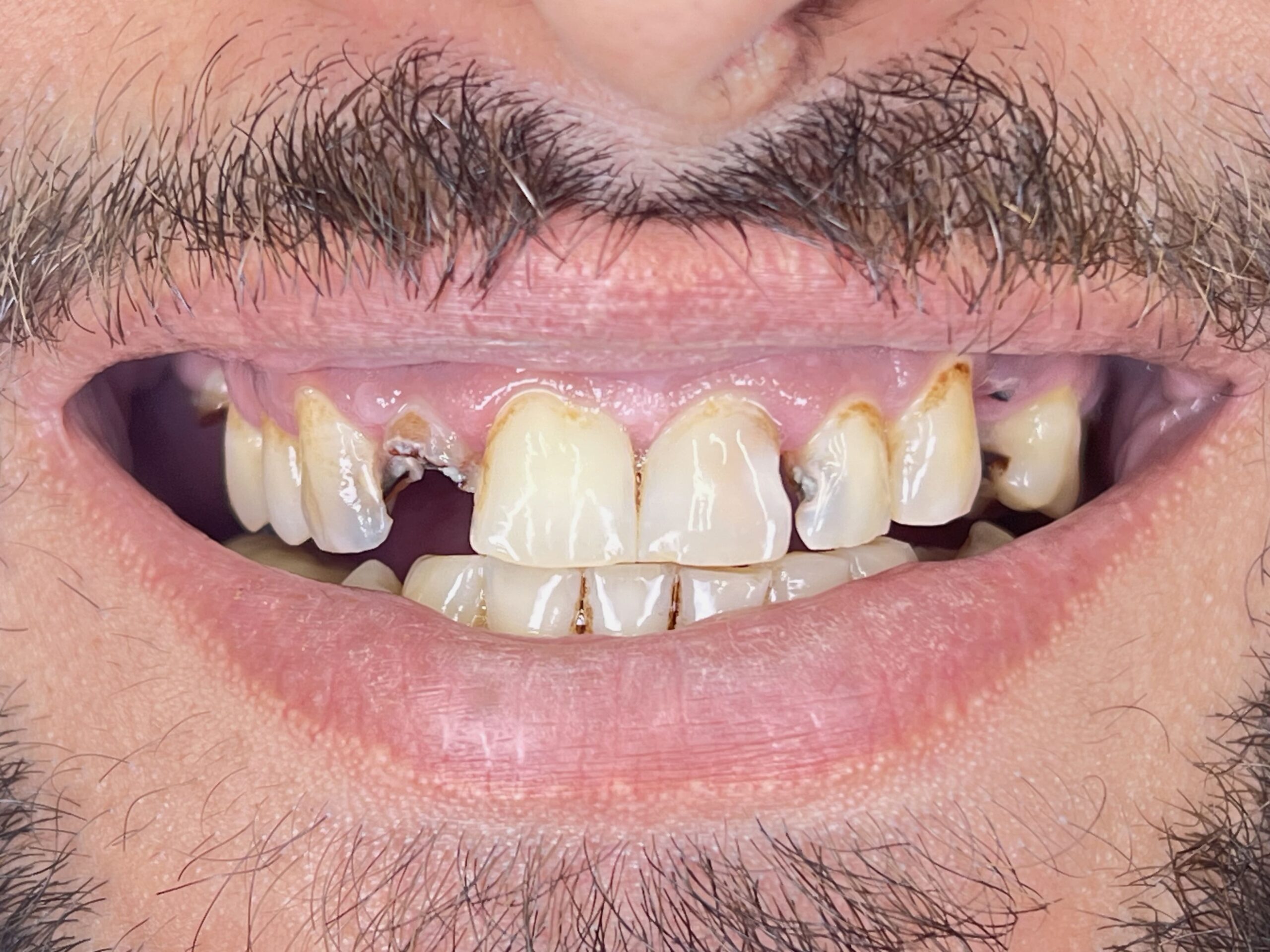 Θήκες Ζιρκονίας Before