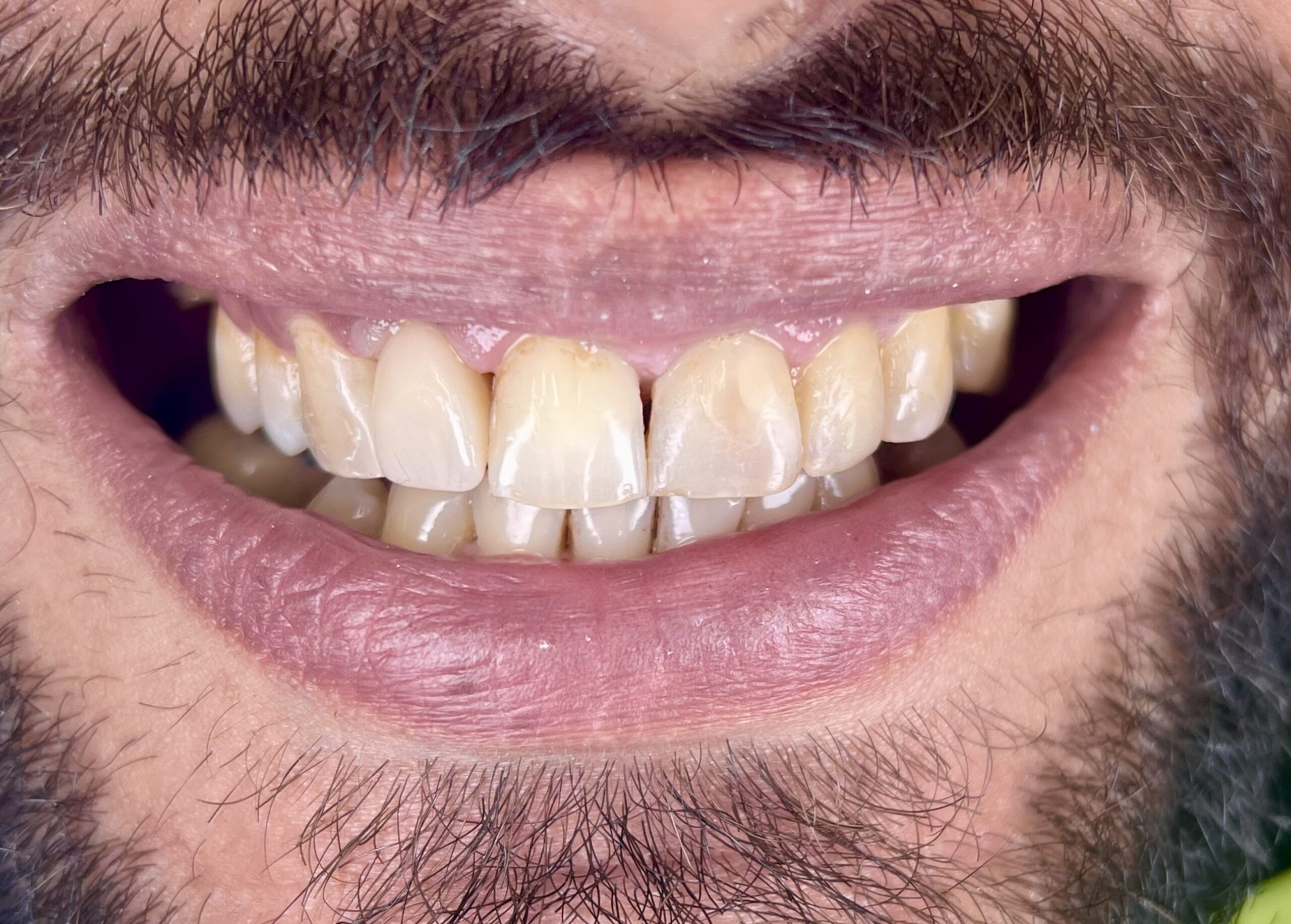 Θήκες Ζιρκονίας After